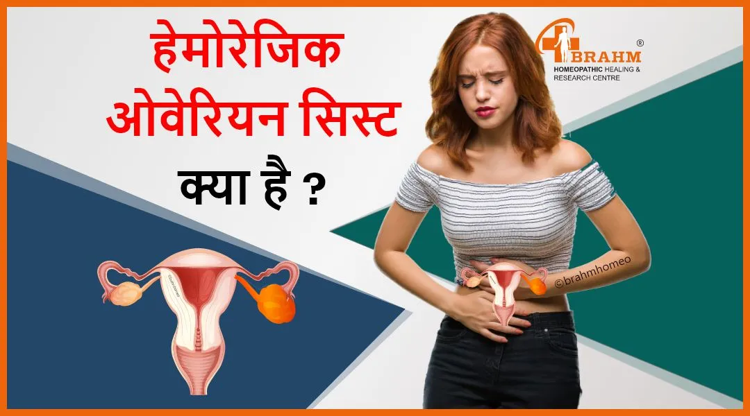 Ovarian Cyst In Hindi Meaning: अंडाशय पुटी (ओवेरियन सिस्ट) का संपूर्ण परिचय और उपचार