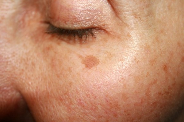 Pigmentation In Hindi Meaning: त्वचा रंजकता के कारण, प्रकार और स्थायी उपचार