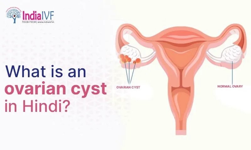 Ovarian Cyst In Hindi Meaning: अंडाशय पुटी (ओवेरियन सिस्ट) का संपूर्ण परिचय और उपचार