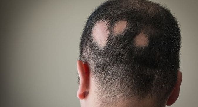Alopecia Meaning In Hindi: एलोपेसिया (बाल झड़ना/गंजापन) के कारण, लक्षण और उपचार 9 एलोपेसिया के प्रकार: हिंदी में नाम और विवरण (Alopecia ke prakar: Hindi mein naam aur vivaran)