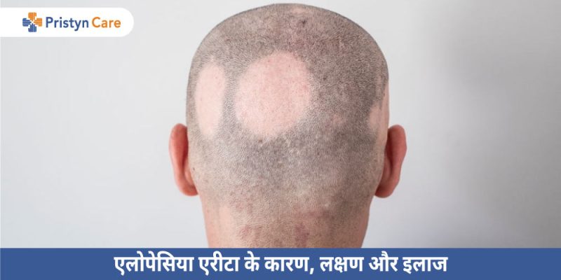 Alopecia Meaning In Hindi: एलोपेसिया (बाल झड़ना/गंजापन) के कारण, लक्षण और उपचार 10 एलोपेसिया के कारण: हिंदी में विवरण (Alopecia ke karan: Hindi mein vivaran)