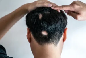 alopecia meaning in hindi 4
