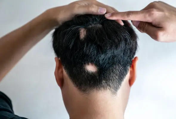 Alopecia Meaning In Hindi: एलोपेसिया (बाल झड़ना/गंजापन) के कारण, लक्षण और उपचार 11 एलोपेसिया के लक्षण: हिंदी में पहचान (Alopecia ke lakshan: Hindi mein pahchan)
