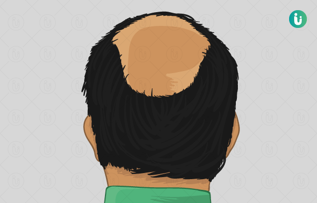 Alopecia Meaning In Hindi: एलोपेसिया (बाल झड़ना/गंजापन) के कारण, लक्षण और उपचार 12 एलोपेसिया का निदान: हिंदी में प्रक्रिया (Alopecia ka nidan: Hindi mein prakriya)