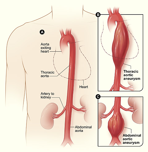 aneurysm meaning in hindi - Hình 2