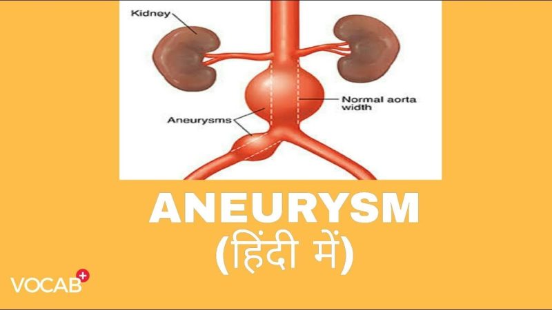 aneurysm meaning in hindi - Hình 3
