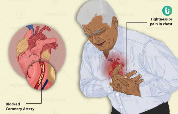 एंजाइना का उपचार: दवाएं, जीवनशैली में बदलाव और प्रक्रियाएं (Angina ka upchar: Davaien, jivanshaili mein badlav aur prakriyaen)