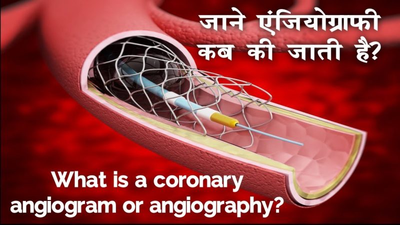एंजियोग्राफी कैसे की जाती है: प्रक्रिया और तकनीक