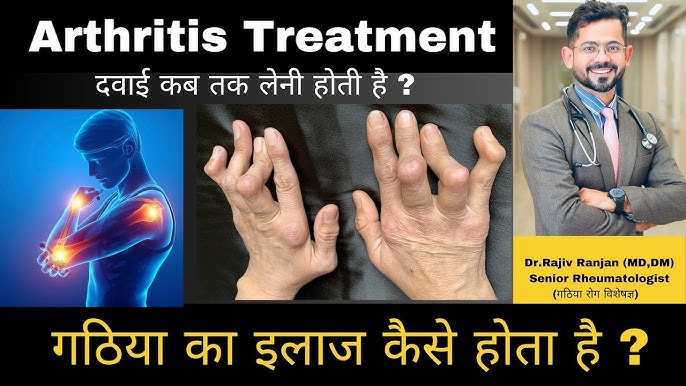 गठिया का उपचार: हिंदी में दवाएं, थेरेपी और सर्जरी (gathiya ka upachaar: hindi mein davaen, therepi aur surgery)