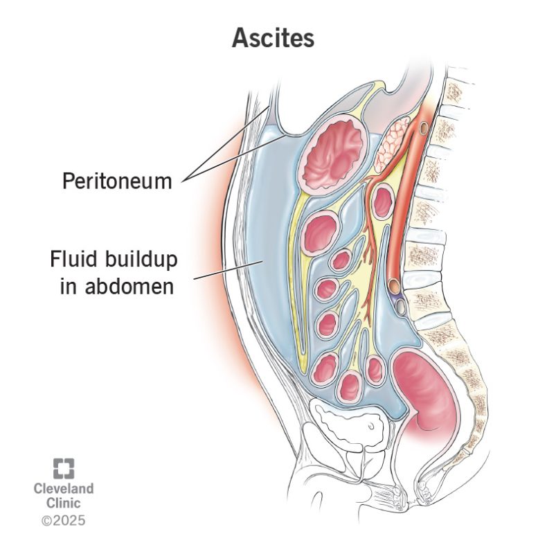 Ascites Kya Hai? (Ascites क्या है?)