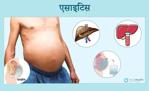 Ascites Ke Pramukh Karan (Ascites के प्रमुख कारण)