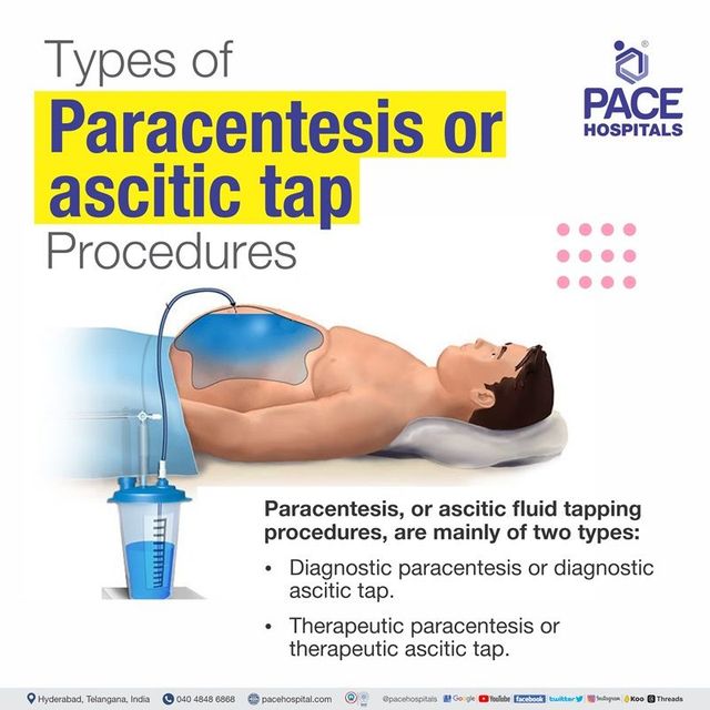 Ascites Ka Pata Lagane Ke Tarike (Ascites का पता लगाने के तरीके)