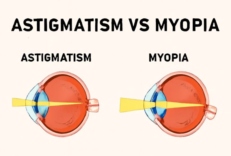 दृष्टि वैषम्य (Astigmatism) क्या है?