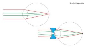 astigmatism meaning in hindi 3