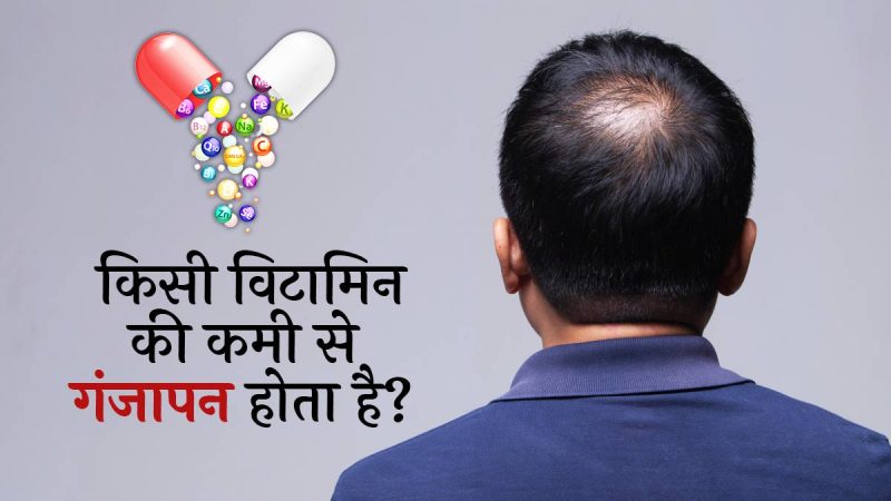 गंजापन: मिथक बनाम तथ्य (Ganjapan: Mithak banam Tathya)  गंजापन से जुड़े सामान्य मिथकों का खंडन करें और वैज्ञानिक तथ्यों के आधार पर सही जानकारी प्रदान करें।