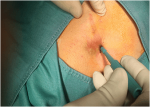 biopsy meaning in hindi 3