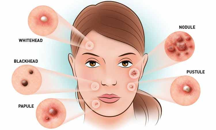 विभिन्न प्रकार के Blemishes (Vibhinn prakar ke blemishes)