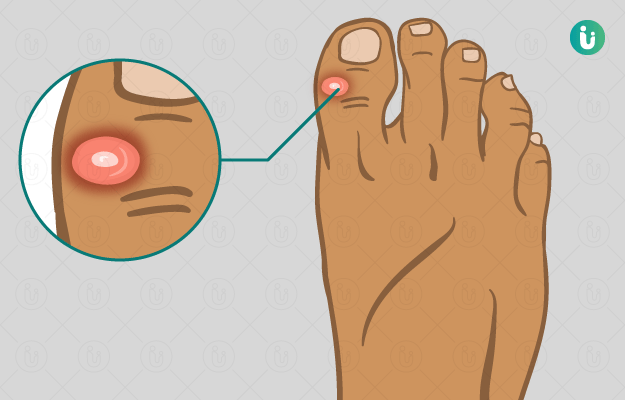 फफोले का हिंदी में अर्थ: संपूर्ण व्याख्या (Blister meaning in Hindi: Complete Explanation)