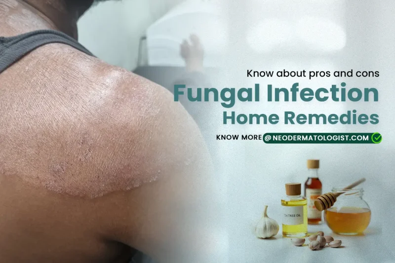 फफोले से राहत: घरेलू उपचार और सावधानियां (Blister Relief: Home Remedies and Precautions)
