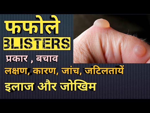 फफोले से बचाव: रोकथाम के उपाय (Blister Prevention: Preventive Measures)