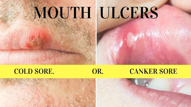 फफोले बनाम छाले: अंतर और उपचार (Blister vs. Sore: Differences and Treatments)