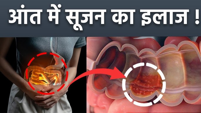 आंत रोगों के लिए चिकित्सा उपचार (Aant rogon ke lie chikitsa upchar)