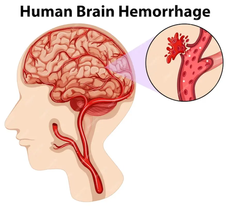 ब्रेन हेमरेज क्या है? हिंदी में पूरी जानकारी, कारण, लक्षण और इलाज 8 brain hemorrhage meaning in hindi - Hình 2