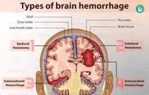 brain hemorrhage meaning in hindi