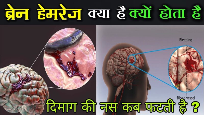 ब्रेन हेमरेज क्या है? हिंदी में पूरी जानकारी, कारण, लक्षण और इलाज 7 brain hemorrhage meaning in hindi - Hình 3