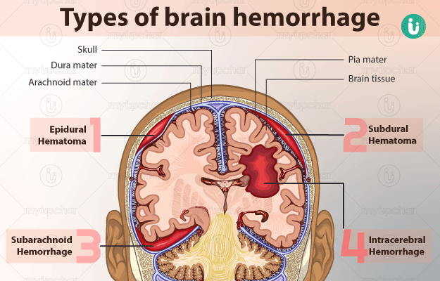 ब्रेन हेमरेज क्या है? हिंदी में पूरी जानकारी, कारण, लक्षण और इलाज 9 brain hemorrhage meaning in hindi - Hình 1