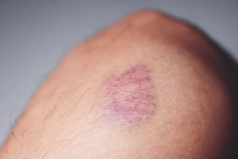 bruising meaning in hindi - Hình 2