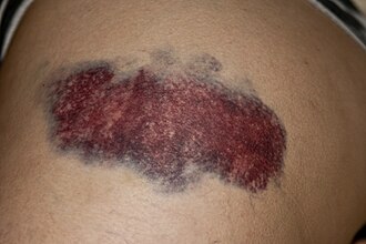 bruising meaning in hindi - Hình 5
