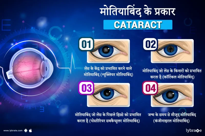 मोतियाबिंद के लक्षण (Motiyabind ke lakshan)  मोतियाबिंद के सामान्य लक्षणों का वर्णन करना, जैसे कि धुंधली दृष्टि, रात में देखने में कठिनाई, और रंगों का फीका पड़ना।