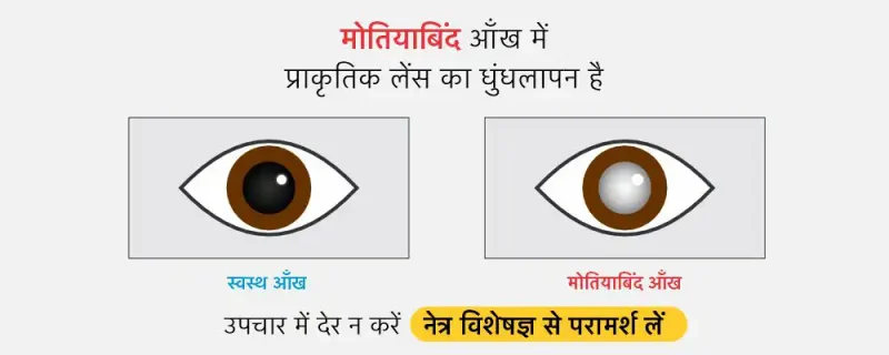 मोतियाबिंद के प्रकार (Motiyabind ke prakar)  विभिन्न प्रकार के मोतियाबिंदों की चर्चा करना, जैसे कि परमाणु मोतियाबिंद, कॉर्टिकल मोतियाबिंद, और पोस्टीरियर सबकैप्सुलर मोतियाबिंद।