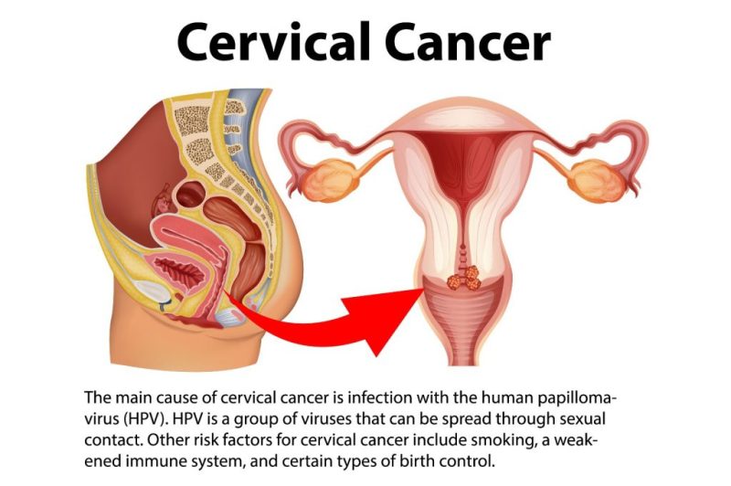 गर्भाशय ग्रीवा का हिंदी में अर्थ: Cervical Meaning in Hindi – एक व्यापक गाइड (Cervical Meaning in Hindi: A Comprehensive Guide)