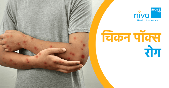 चिकन पॉक्स का हिंदी में मतलब क्या है? (Chicken Pox ka Hindi mein matlab kya hai?)  चिकन पॉक्स शब्द का शाब्दिक अर्थ और हिंदी भाषा में इसके सामान्य उपयोग को समझें, साथ ही इस बीमारी से जुड़े लक्षणों और उपचारों के बारे में जानें।