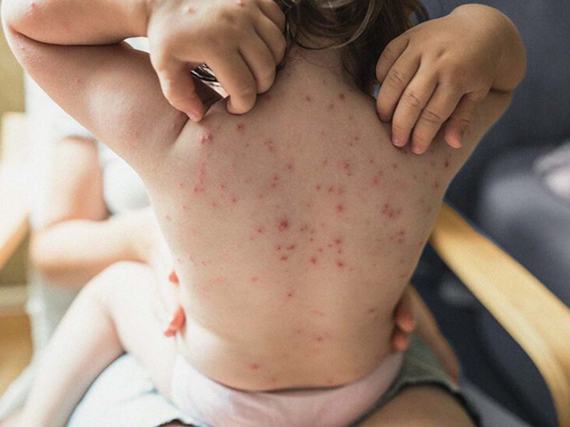 चिकन पॉक्स के लक्षण और निदान (Chicken Pox ke lakshan aur nidaan)  चिकन पॉक्स के विशिष्ट लक्षणों को पहचानें, जैसे कि खुजली वाले दाने और बुखार, और समझें कि डॉक्टर इसका निदान कैसे करते हैं।