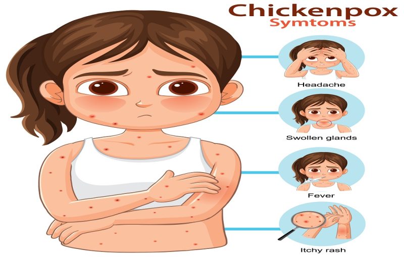 चिकन पॉक्स का कारण और प्रसार (Chicken Pox ka karan aur prasar)  जानें कि चिकन पॉक्स कैसे फैलता है, इसके कारणों, संक्रमण के तरीके और रोकथाम के उपायों को समझें।
