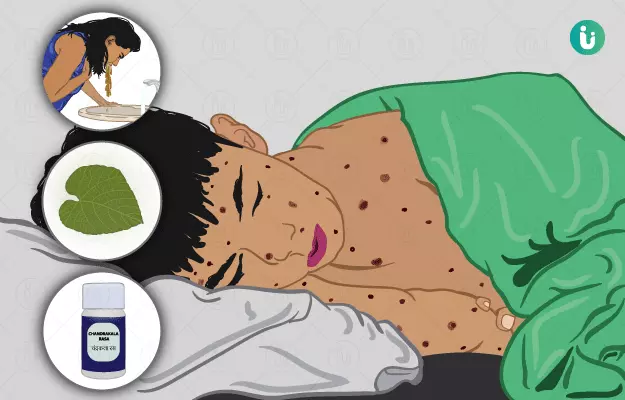 चिकन पॉक्स का उपचार और रोकथाम (Chicken Pox ka upchar aur roktham)  चिकन पॉक्स के लिए उपलब्ध विभिन्न उपचार विकल्पों, जैसे कि घरेलू उपचार, दवाएं और टीकाकरण के बारे में जानें, और बीमारी को फैलने से रोकने के लिए उठाए जा सकने वाले कदमों को समझें।