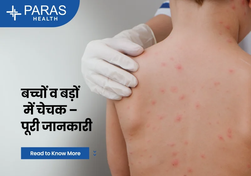 बच्चों में चिकन पॉक्स: विशेष ध्यान (Bachchon mein Chicken Pox: vishesh dhyan)  बच्चों में चिकन पॉक्स के विशेष लक्षणों, उपचारों और देखभाल की आवश्यकताओं पर ध्यान दें।