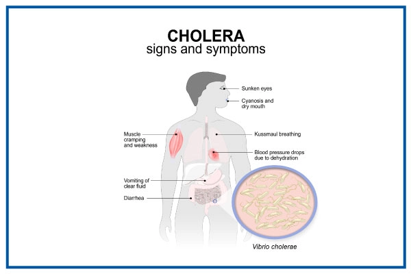 हैजा के कारण और जोखिम कारक (Cholera Ke Karan Aur Jokhim Karak)