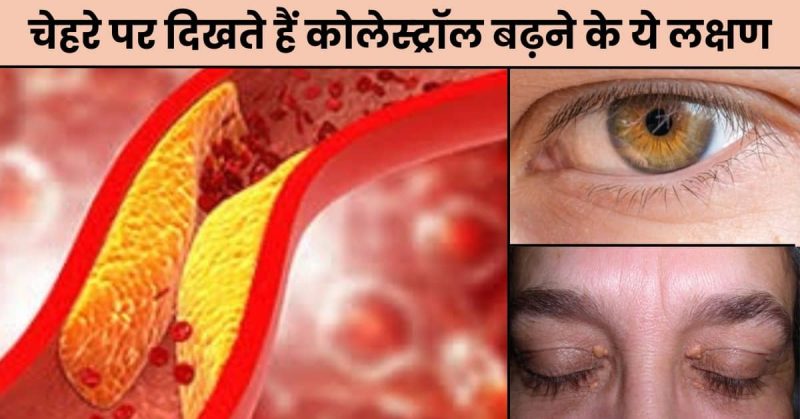 उच्च कोलेस्ट्रॉल के कारण: हिंदी में समझें (Ucch cholesterol ke karan: Hindi mein samjhein)