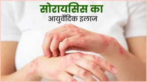 cirrhosis meaning in hindi 5