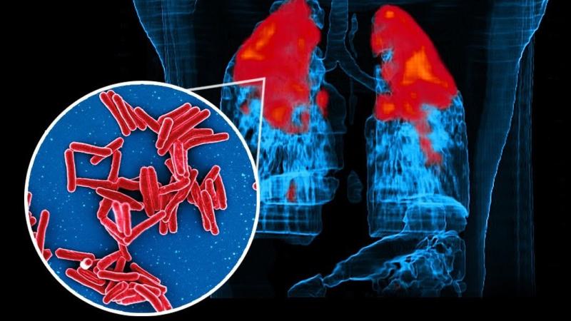 क्लॉस्ट्रोफोबिया के कारण: आनुवंशिकी, अनुभव और मस्तिष्क रसायन शास्त्र