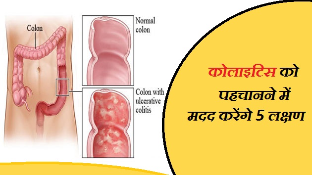 कोलाइटिस के लक्षण: हिंदी में पहचानें (Colitis ke lakshan: Hindi mein pahchanen)  इस खंड में कोलाइटिस के सामान्य लक्षणों (जैसे पेट दर्द, दस्त, खून आना) को हिंदी में समझाया जाएगा ताकि लोगों को शुरुआती पहचान में मदद मिल सके।