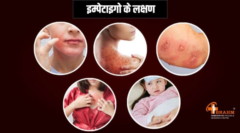 चिकित्सीय और अन्य सामान्य उपयोग: घाव की पपड़ी और बाहरी परत