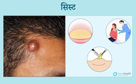 सिस्ट का हिंदी में अर्थ: एक विस्तृत परिभाषा (Cyst ka hindi mein arth: Ek vistrit paribhasha)