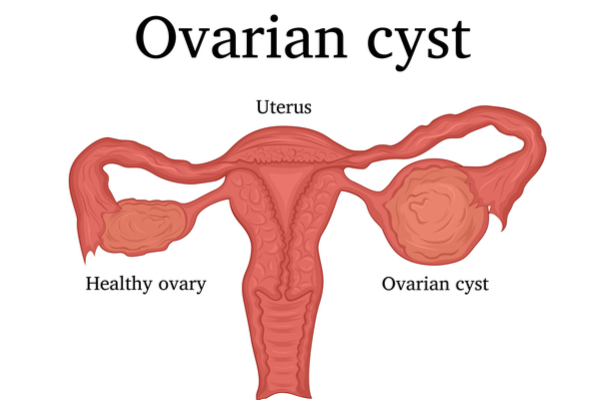 चिकित्सा संदर्भ में सिस्ट के विभिन्न प्रकार (Chikitsa sandarbh mein cyst ke vibhinn prakar)