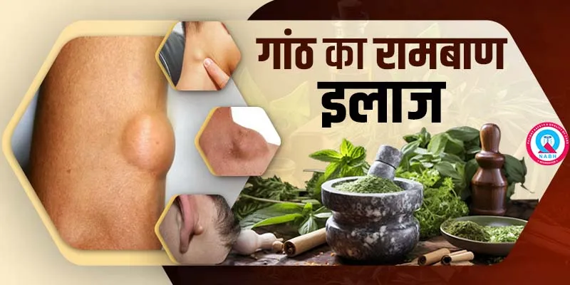 सिस्ट उपचार के विकल्प: सर्जरी, दवाएं और घरेलू उपचार (Cyst upchar ke vikalp: Surgery, davaiyan aur gharelu upchar)