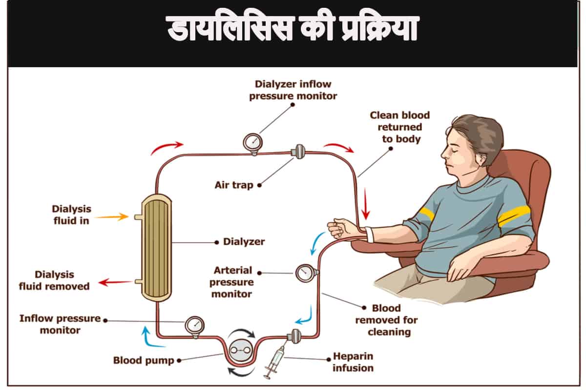 डायलिसिस कब आवश्यक है: परिस्थितियाँ और कारण